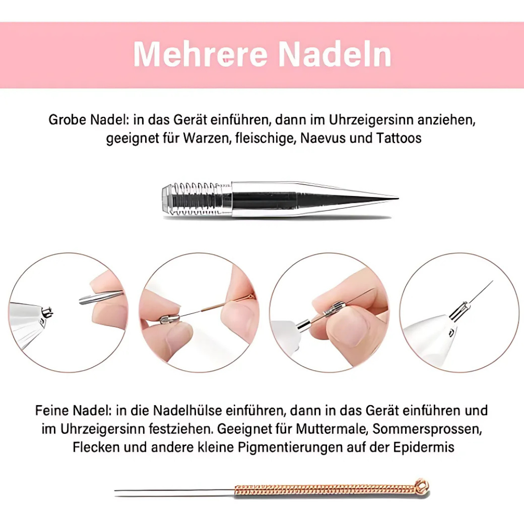 Plasma-Stift zur sicheren Entfernung von Hautmakeln
